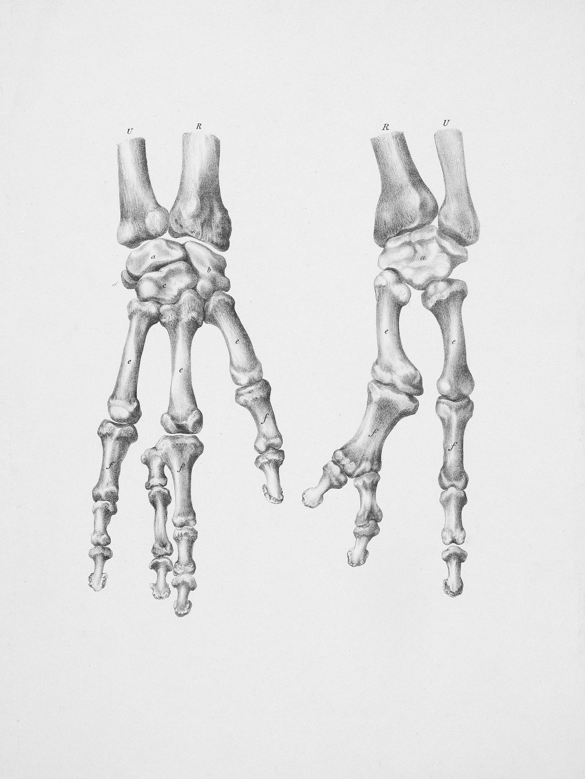 osteoarthritis
